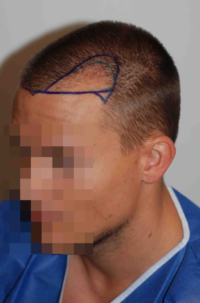 FUE intake Minoxidil