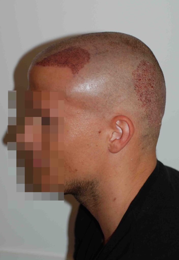 FUE aftercare Minoxidil