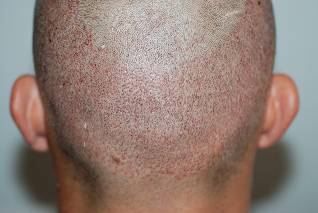 donor area FUE minoxidil