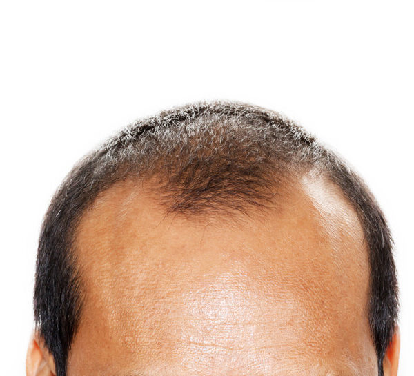 hair loss types