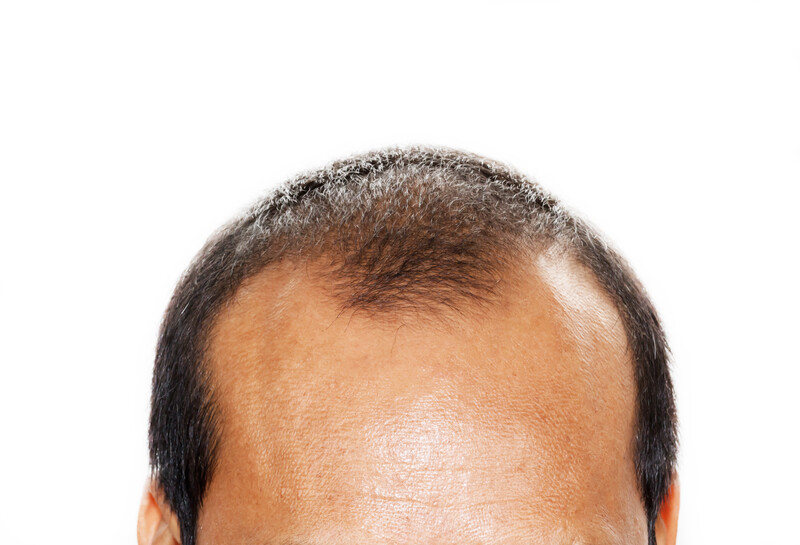 hair loss types