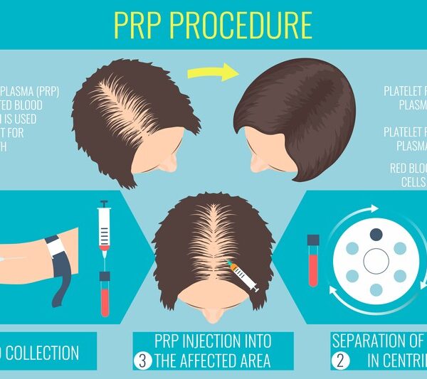 prp hair loss