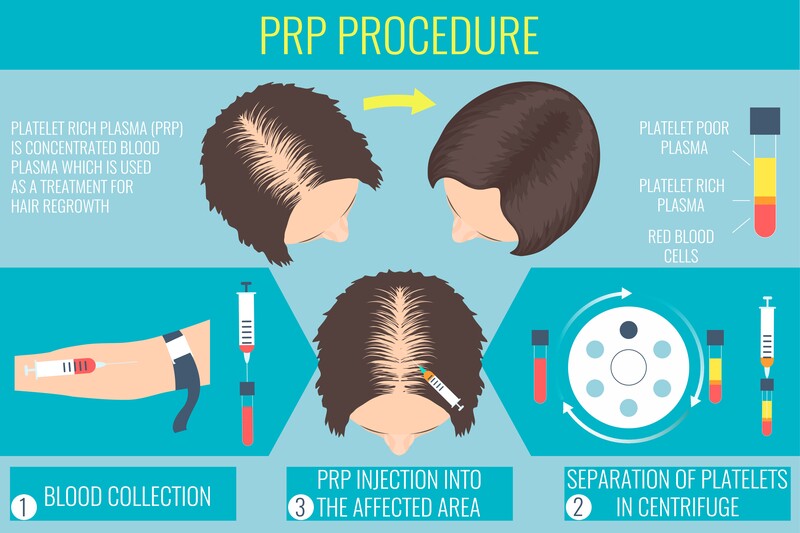 prp hair loss