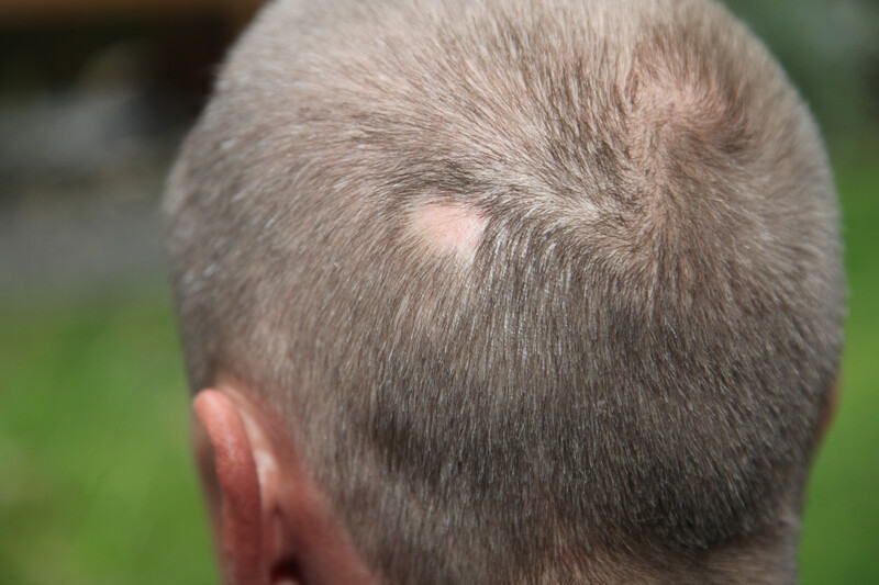 Alopecia areata