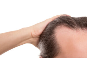Receding hairline Minoxidil