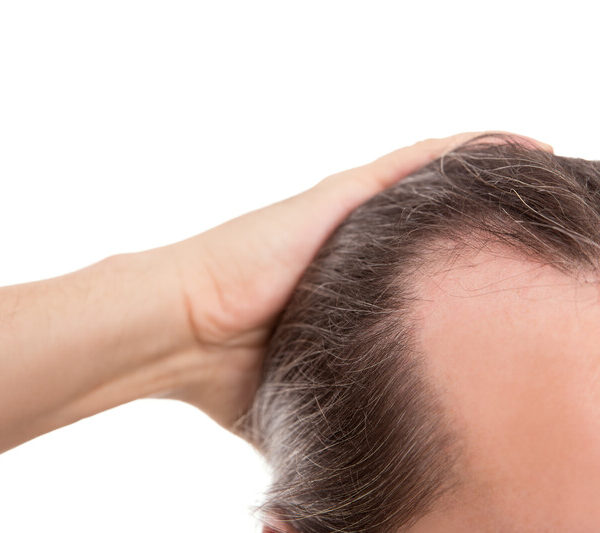 Receding hairline Minoxidil
