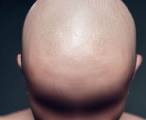 Alopecia Universalis