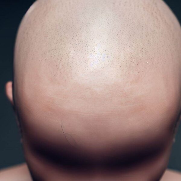 Alopecia Universalis