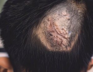 Scarring Alopecia
